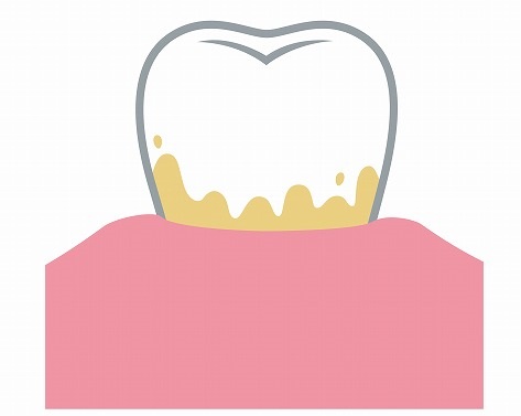 歯石とは、歯垢が固まったもの