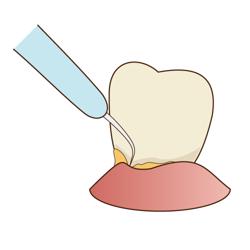 超音波スケーラーによる歯石除去・歯周ポケットのクリーニング
