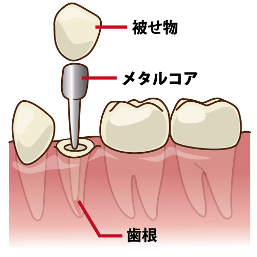 かぶせもの（差し歯）とインプラントはどう違う？