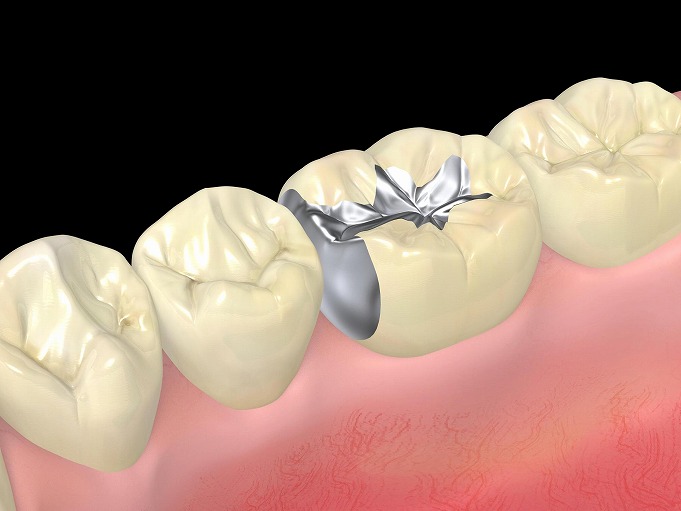 保険の銀歯