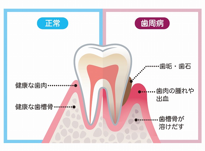 歯周病は、「骨が溶けてしまう」病気です